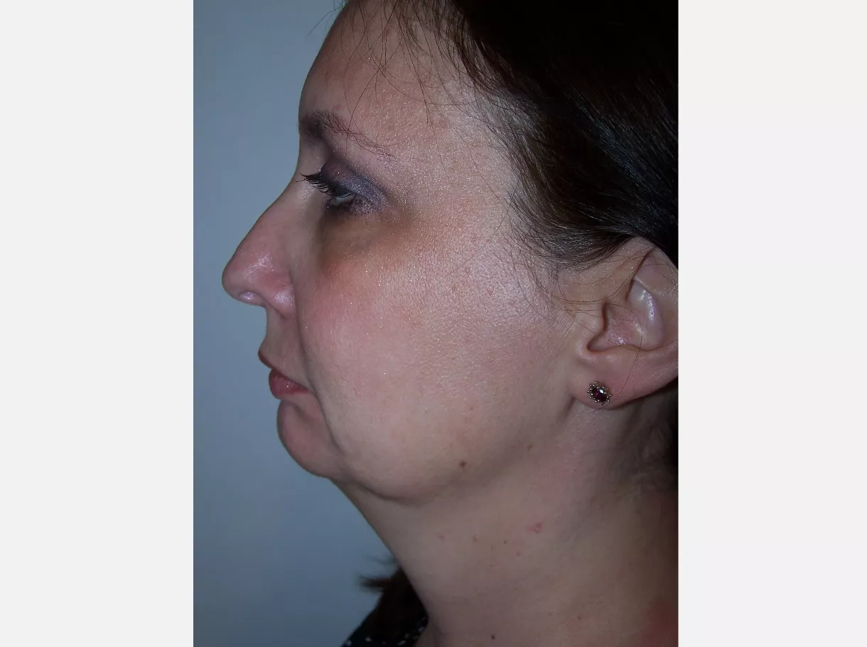 corrective jaw surgery before