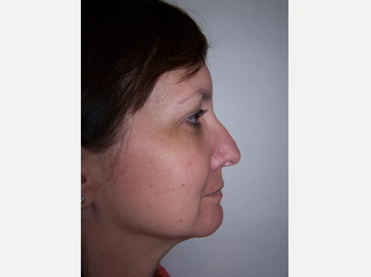 corrective jaw surgery after