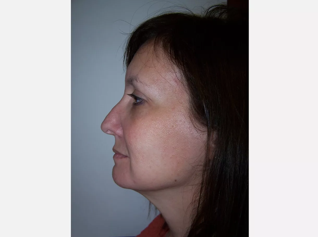 corrective jaw surgery after