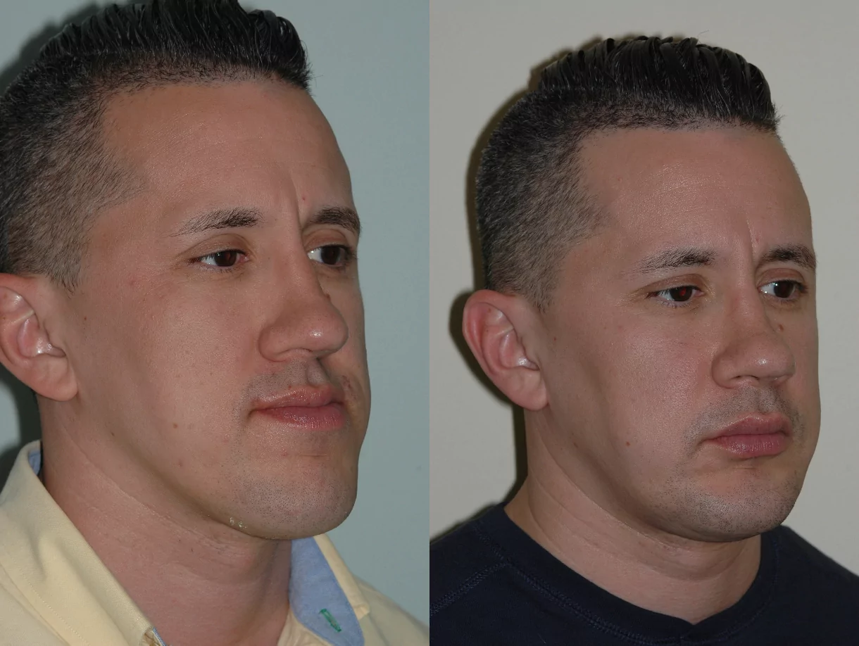corrective jaw before and after