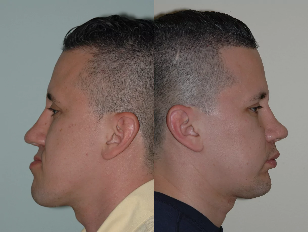 corrective jaw before and after
