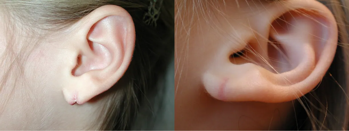 earlobe repair before after