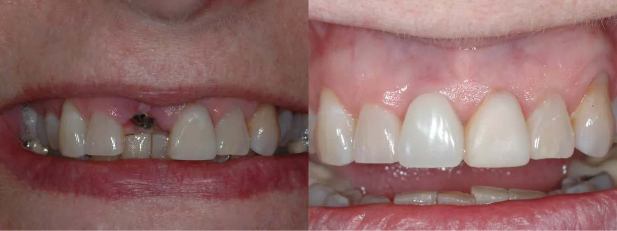 emergency dental implants before and after