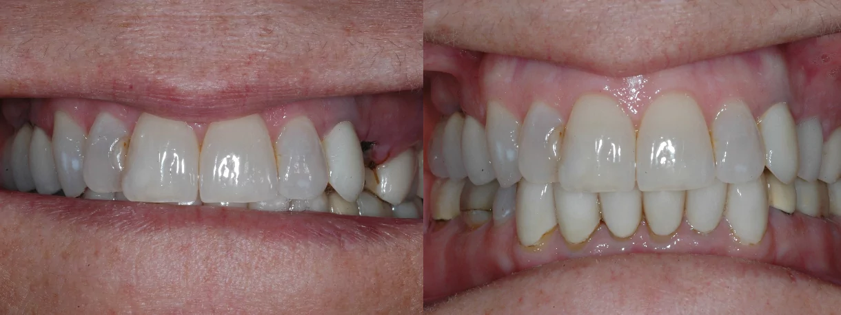 emergency dental implants before and after