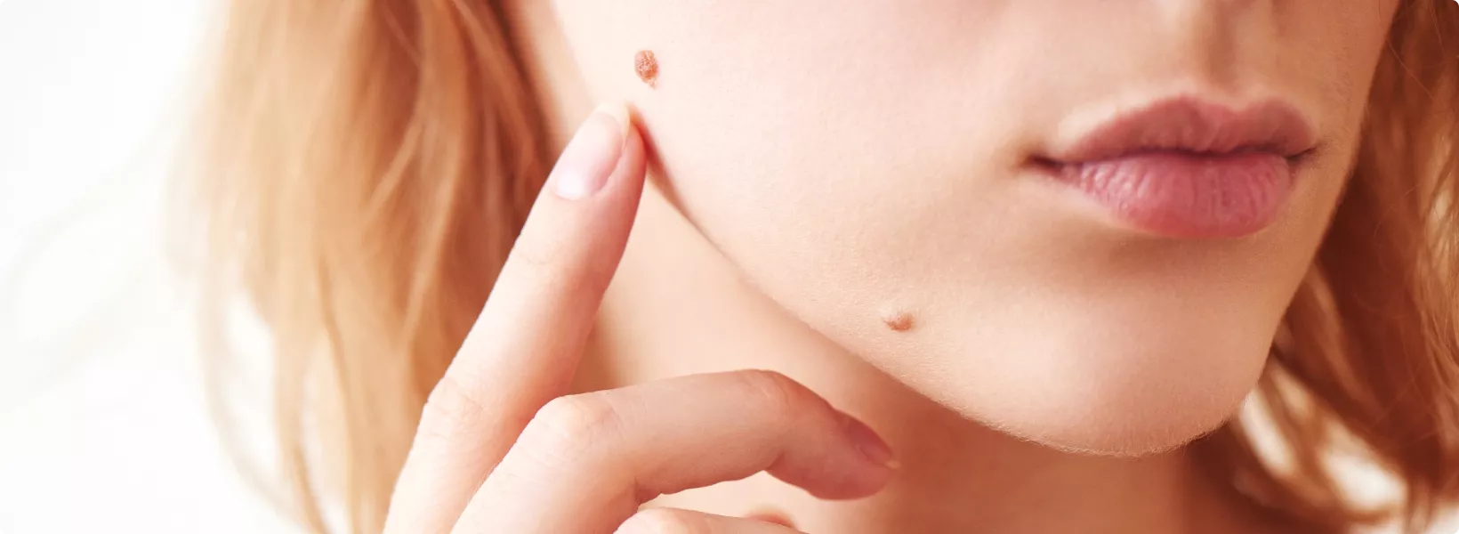 woman with moles