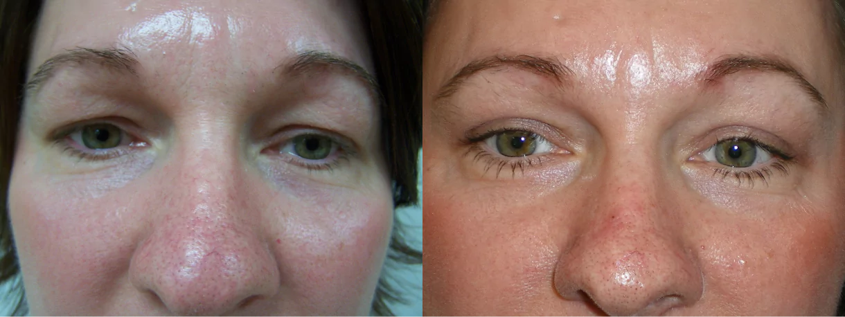 upper eyelid lift before after